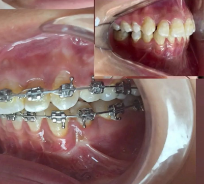 Traitement orthodontique après — Cabinet Dr Elkabiri El Jadida