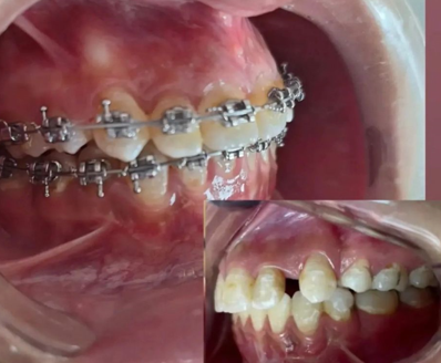 Traitement orthodontique avant — Cabinet Dr Elkabiri El Jadida