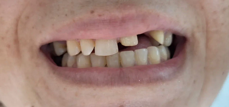 Implant et facettes avant — Cabinet Dr Elkabiri El Jadida